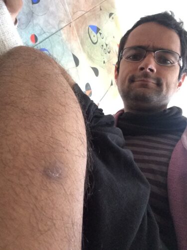 the scar today, about one and a half months later (Norway, August 1st, '17)